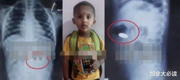 印度3歲男孩誤吞硬幣，被三傢醫院拒收後，回傢吃水果當晚暴斃-圖1