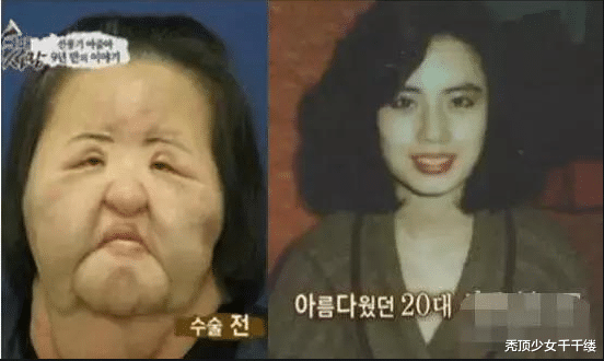 韓國女模特整容上癮失去理智，註射食用油毀容，面部醜陋異常-圖1